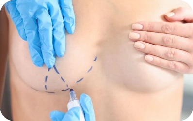 Breast lift (mastopexy)
